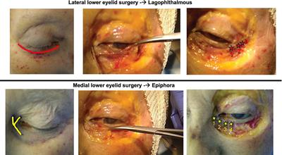 Combining early lower eyelid surgery with neuromuscular retraining for synkinesis prevention after facial palsy: the role of the eye in aberrant facial nerve regeneration